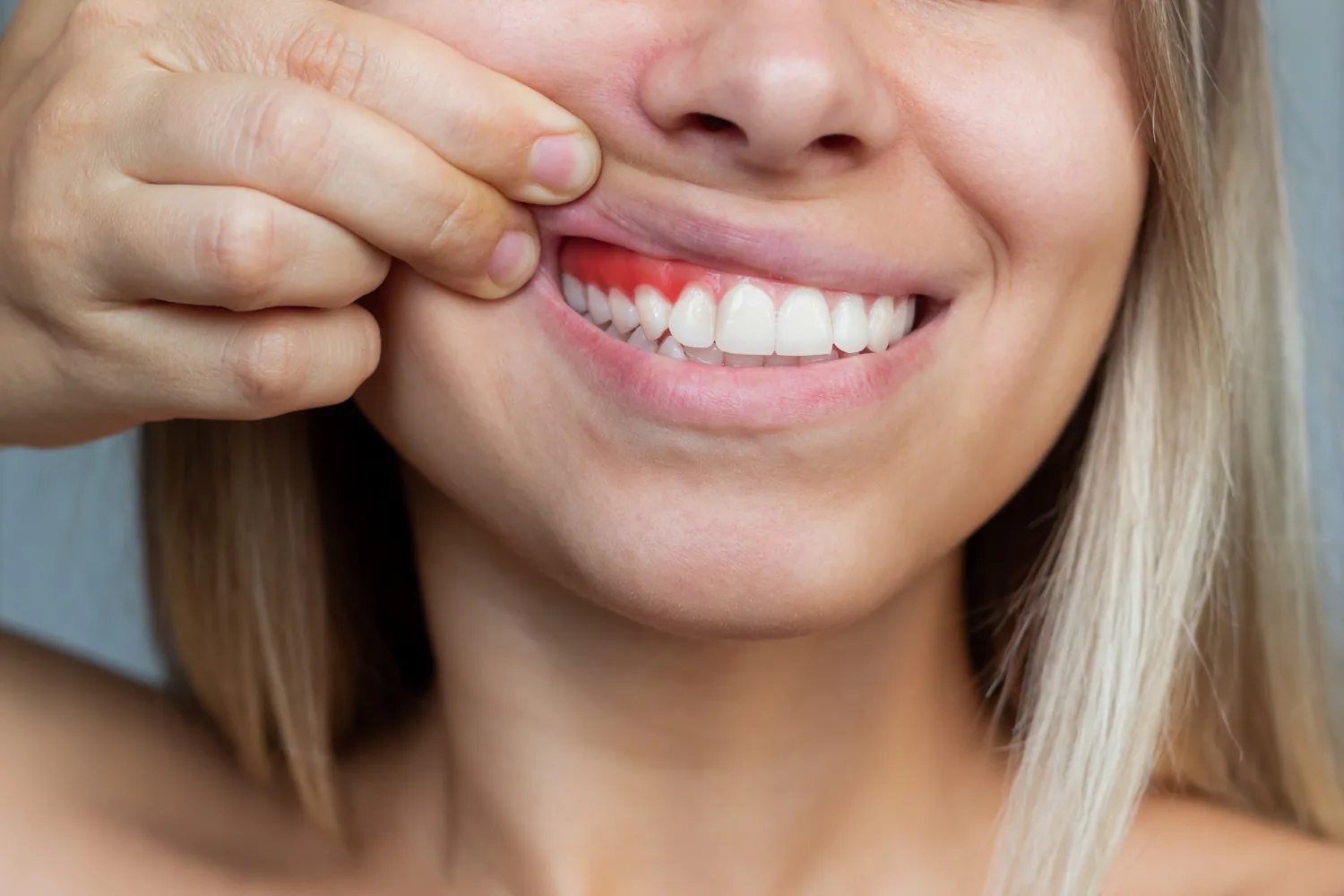 Bleeding Gums
